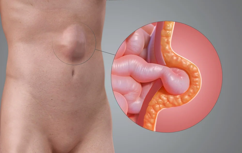 Hernia epigástrica monterrey