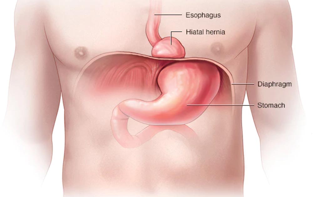 Hernia Hiatal
